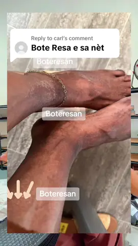 Replying to @carl merci Queen 😘🫶🏽nou menm ki beswen fè po nou bel klike anba pou pran yon serum ou pap peye shipping #beauty #boteresan #GlowingSkin #tiktokskincare #beautytips 