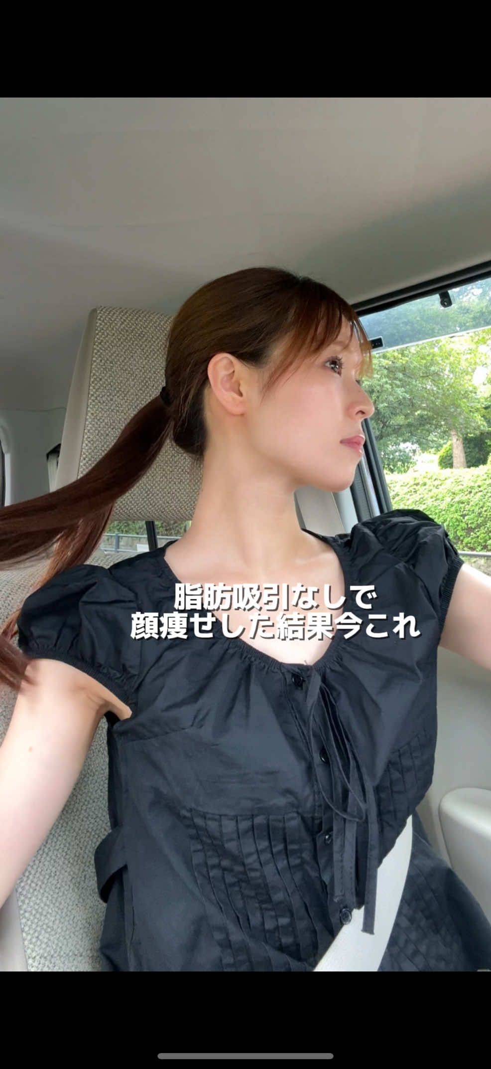 脂肪吸引なしで顔痩せして今これ#ダイエット#痩せる#垢抜け 
