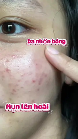 Nếu bạn đang khổ sở vì da dầu, mụn tuổi dậy thì, da nhạy cảm thì THỬ NGAY nha #srm #Ylee #tuoidaythi #nguamun #Huỳnhanh 
