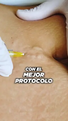 Trata tus estrías con el mejor protocolo que regenera y cuida tu piel. 🤗🧑🏻‍⚕️ ✅Disminuye la profundidad y el color de las estrías ✅Ayuda a promover colágeno y elastina ✅Tratamiento altamente preciso ✅Tecnología láser de última generación que cuida tu piel 📍 Visítanos en: Av. Benavides 1967 - Miraflores Lunes a Sábado, de 9:00 A.M. a 8:30 P.M. 986 742 307 / 994 023 520 #foryoupage❤️❤️ #parati #trend #estetica #Lumeniz #expertosenláser #estrias #bioxigeno #láserco2 #laserco2fracionado #cicatrices #estriasembarazo #estriasposparto