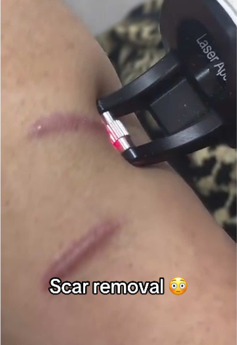 I like my scars 🙃 #scar #laser #shoutoutot (via lasermorvarid/IG)