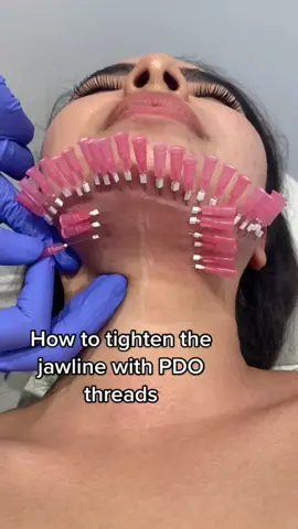 PDO Thread Lift Face Lift #facelift #pdothreads #popular #fyp #threadift #plasticsurgery #beforeafter #beauty #pdo 