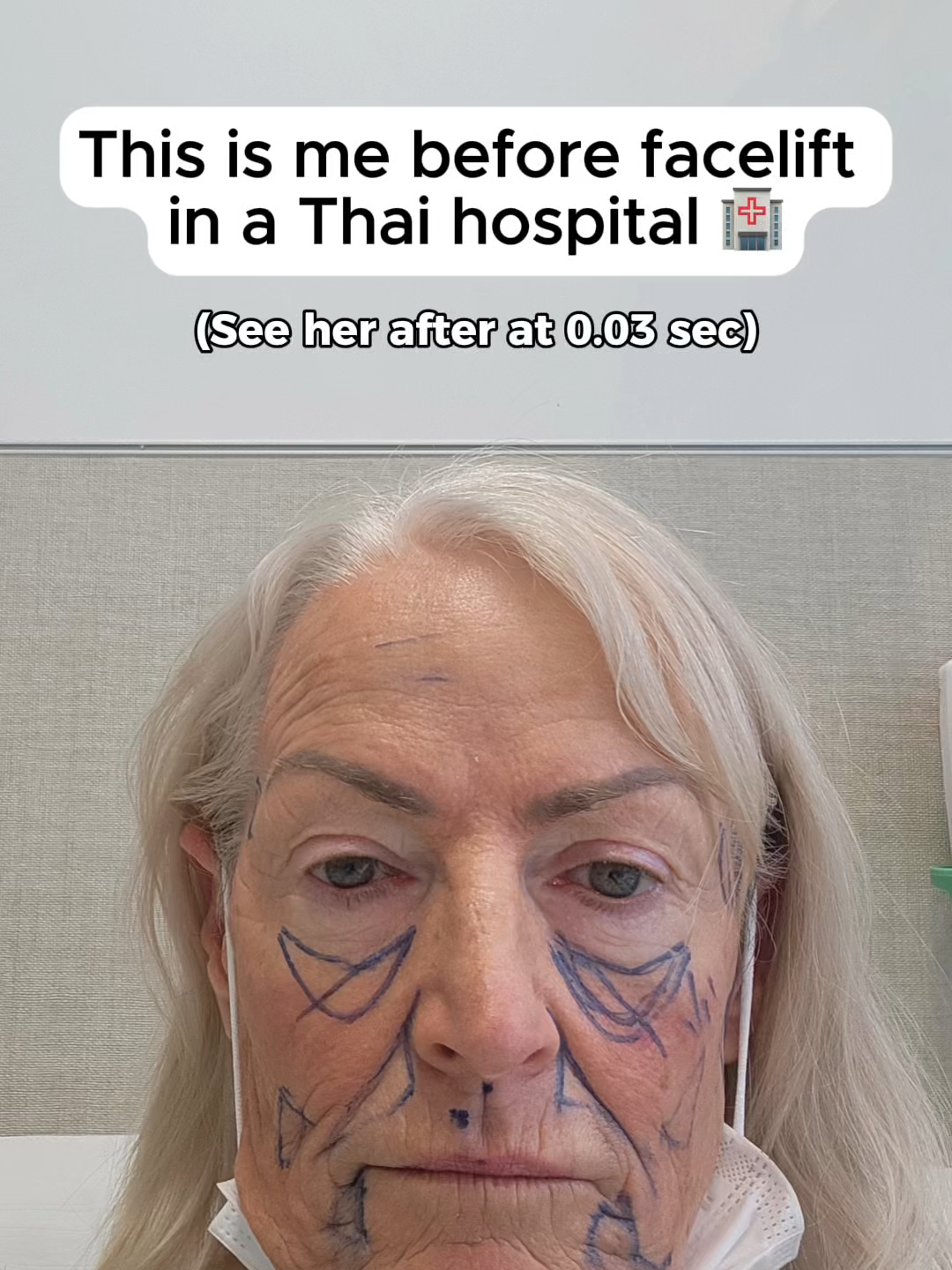 10 days post-facelift transformation! Lynn shares her experience having facelift surgery with Destination Beauty in Thailand 🇹🇭✨ Dr. NJ performed✨: ✅ Full facelift ✅ Neck lift ✅ Fat transfer to the face #facelift #destinationbeauty #faceliftsurgery #necklift