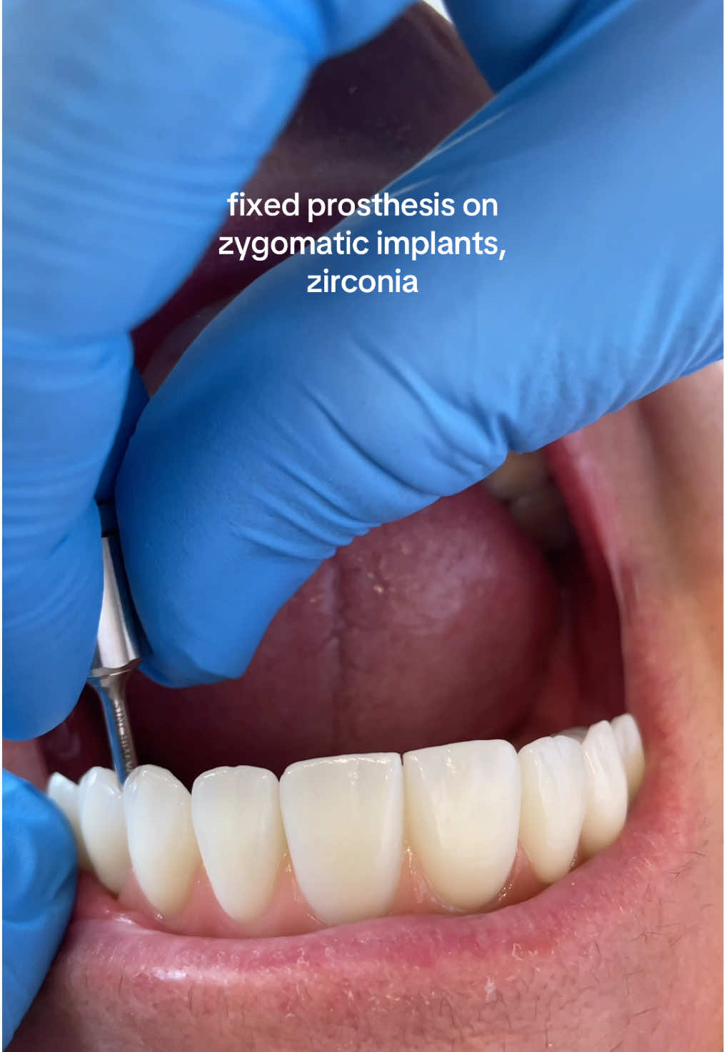 Implantes dentários ainda são a melhor forma de reabilitar para quem perdeu todos os dentes.  Dental implants are still the best way to rehabilitate those who have lost all their teeth.  #odontologia #dentalimplants #dentistry #dentista #implanteszigomaticos 