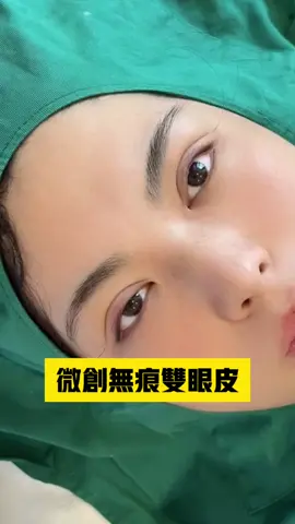 #全切雙眼皮#無痕雙眼皮#眼修復#眼瞼下垂#腫眼泡#去眼袋