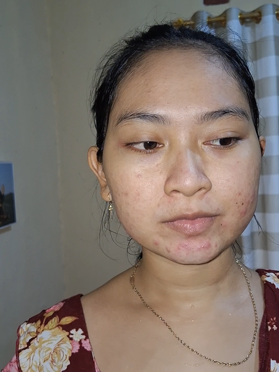 kalian sama ga sih? kalo tamu bulanan dateng pasti jerawat ikut dateng🙃#pejuangjerawat 