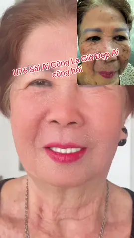 U76 Sài Ai Cũng La Giờ Đẹp Ai cũng hỏi #hotline_0938572642 #đồimồi_đốmnâu #tàn_nhang #bongda #Nám 