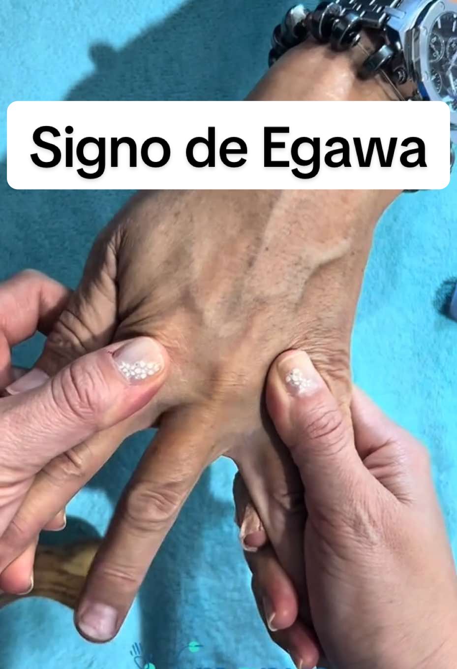 👆🏻El signo de Egawa es una prueba sencilla para valorar si hay afectación del nervio cubital, a través de la función de los músculos interóseos de la mano. 🤟🏻Consiste en pedir al paciente que mueva el dedo medio de un lado a otro como diciendo “NO” ✋🏻Cuando este movimiento es débil o imposible de realizar, hablamos de un signo de Egawa positivo, lo que puede orientar hacia una afectación del nervio cubital. 🖖🏻 Un recordatorio de cómo maniobras aparentemente simples pueden aportar información clave en la exploración de la mano. #Manusfisioterapia #RehabilitaciónDeMano #terapiademano #egawa #exploracionclinica 
