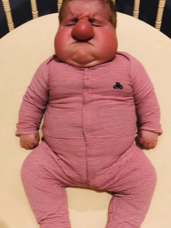 This is the Angry Potato Baby 🥔👃 He rages, turns bright red,  wiggles and kicks like a mini Hulk. But with one lullaby + a belly rub, he transforms instantly : from rage mode to cuddly potato. #PotatoNoseBaby #Baby #RedFaceBaby #ViralBaby