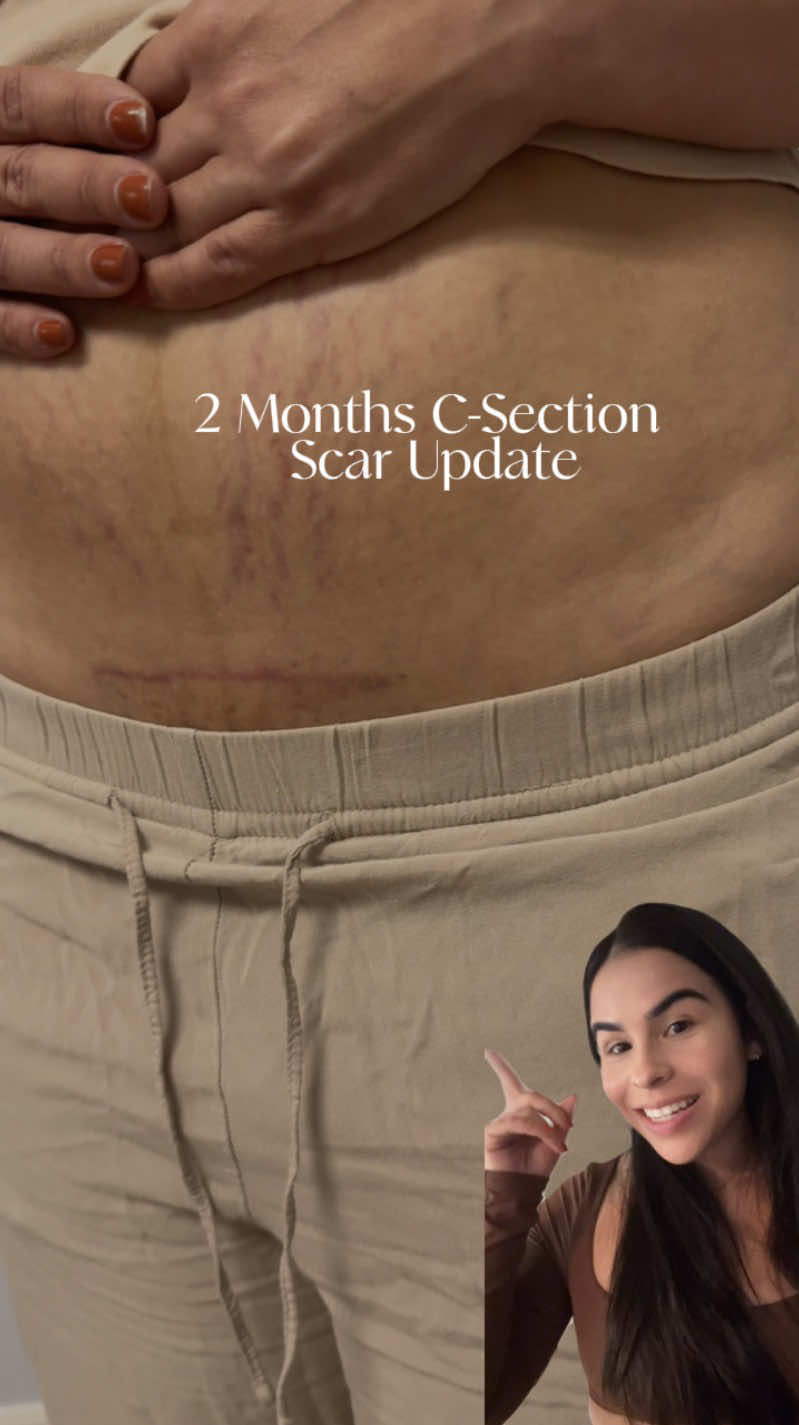 Actualización de mi cicatriz de cesárea | 2 meses postparto . Si estás pasando por lo mismo, recuerda que tu cicatriz no define tu historia, es parte de tu fuerza como mamá 💪 #csectionjourney #csectionrecovery #postpartumbody #postpartumoverything #momlife 