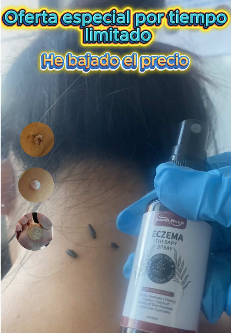 Comparteunspraysúpersimpleyprácticoparaeliminarlasetiquetasdelapiel#VPH#fyp#verruga #hpv m0918-1