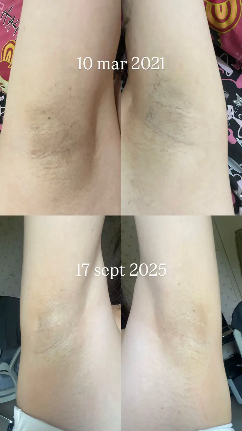 gk dipungkiri ipl hair removal emng berpengaruh banget biar ketiak “kelihatan” lebih cerah karena bulu yg tumbuh jadi lebih tipis jd pori2 ikut mengecil. tp buat mutihin ketiak ini masih struggle banget cari treatment yang CEPET dan EFEKTIF.  at the moment aku cuma pake produk ini aja untuk ngerasat keti :  - glycolic acid : kata orng bisa mutihin tp di aku ga ngaruh, aku pake anyways karena bisa ngilangin bau. no deo, no tawas - moisturizer : aveeno/la roche posay  - ipl 2 bulan sekali (karena bulu udh jarang). no wax ever again (bikin iritasi dan ingrown hair di aku) treatment at the moment :  - derma express underarms glow (will share the progress) kenapa bisa hitam ?  - dari SMP ke kuliah. sekitar 10 tahun lebih sering cukur dan cukurannya ga sering ganti > bikin iritasi berkepanjangan  - pake deodoran yg beredar di minimarket dari SD smpe 5 tahun lalu br coba2 deo yg natural dan akhirnya berakhir ke glycolic produk yg udh dicoba dan ga ngaruh (5 tahun terakhir) : - rintik no bumps  - qnic care thailand  - whitelab  - brightly  setelah coba krim2 ini dan ga ngaruh, aku stop cari krim karena kayanya klo ngaruh pun akan lama banget prosesnya.  treatment yg udh dicoba dan ga ngaruh (5 tahun terakhir)  - zap combo underarm 12x  - zap super brightening 2x  - pico laser eudora 3x - pico laser lunix 6x  - lupa nama treatment nya di scarlett yg ga ngaruh buat ngilangin bau aku :  - tawas segala bentuk dr cair sampai batu - ciara (malah tambah bau)  #underarmwhitening #ketiakhitam 