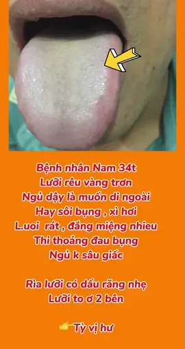 L.ưỡi trắng , miệng đắng , miệng rát ăn uống đầy bụng , ợ hơi di ngoài nhiều k biêt tại sao => tỳ vị hư #tyvihu #traonguocdaday #daybung #luoitrang #dongy #xuhuong 