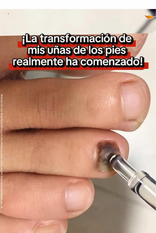 Si tú también tienes esta situación, ¡puedes probar este método!#nailcare #gainknowledge #toenails #tiktokmademebuyit #foryou 