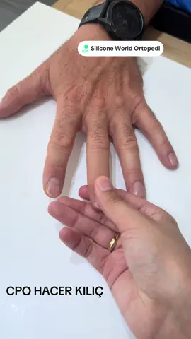 #siliconefinger #prostheticfinger