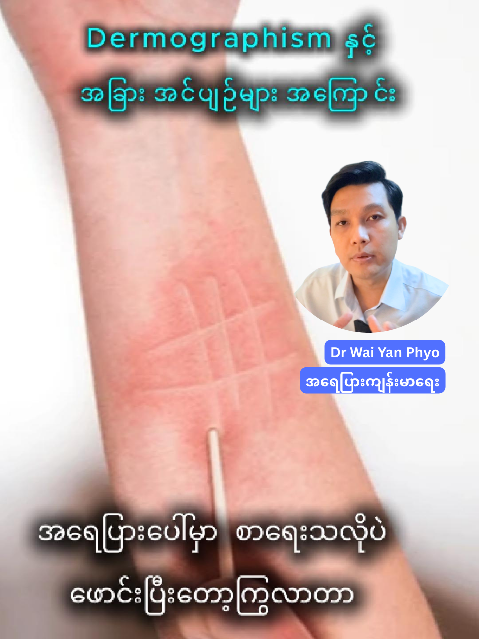#Dermographism နှင့် #အခြားအင်ပျဉ်များအကြောင်း ဘာကြောင့်ဖြစ်ရတာလဲ ဘာတွေသတိထားဖို့လိုလဲ ဘယ်လိုကာကွယ်ရမလဲ  ဘာဆေးသောက်လို့ရလဲ ဘယ်အချိန်ဆရာဝန်နဲ့ပြသရမလဲ #ဒေါက်တာဝေယံဖြိုး #အရေပြားကျန်းမာရေးဆရာဝန် MBBS DPD(UK) MSc PD(UK) #အင်ပြင်ဖြစ်လာတဲ့အဓိကအကြောင်းအရင်း  မင်္ဂလာပါခင်ဗျာ... အဝေးရောက်နေတဲ့သူ (သို့) Telemedicine နဲ့ပြချင်သူတွေကတော့. My-Medicine (Viber) Number +959773583564 ကို စာပို့/ဖုန်းခေါ် ဆက်သွယ်ပြီးရက်ချိန်းယူနိုင်ပါတယ်။  ဆေးခန်းပြပြီးနောက် လိုအပ်သည့်ဆေးဝါးများပိုချိတ်ဆက်ထားသော ဆေးခန်းများမှ အိမ်အရောက်ပို့ပေးပါတယ်။ ကျေးဇူးတင်ပါတယ်ခင်ဗျာ။