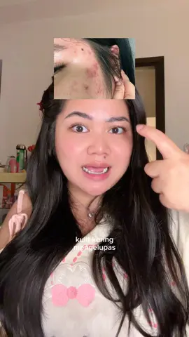 mild cleanser = one step closer to acne free face sumpah trust me on this one
