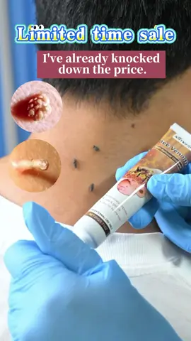 Este removedor de verrugas puede ayudarte con la mayoría #ladymaycream#removal#freckles## aobenz#SaludDeLosPies #SkinCareRoutine#ClearSkinGoals#TikTok Beauty #SkinConfidence#WartRemoval #summerproject#Summer
