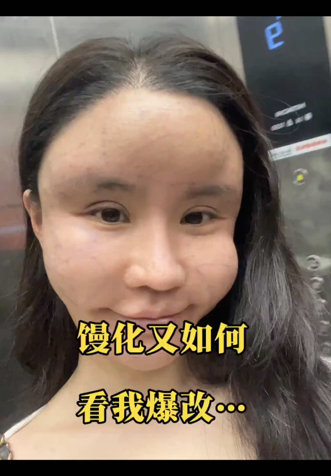馒化脸好严重好焦虑每天靠着褪黑素才可以睡着 找到了西亚老师爆改太完美了#馒化脸 #馒化脸怎么解决 #医美 #整形 #微整 