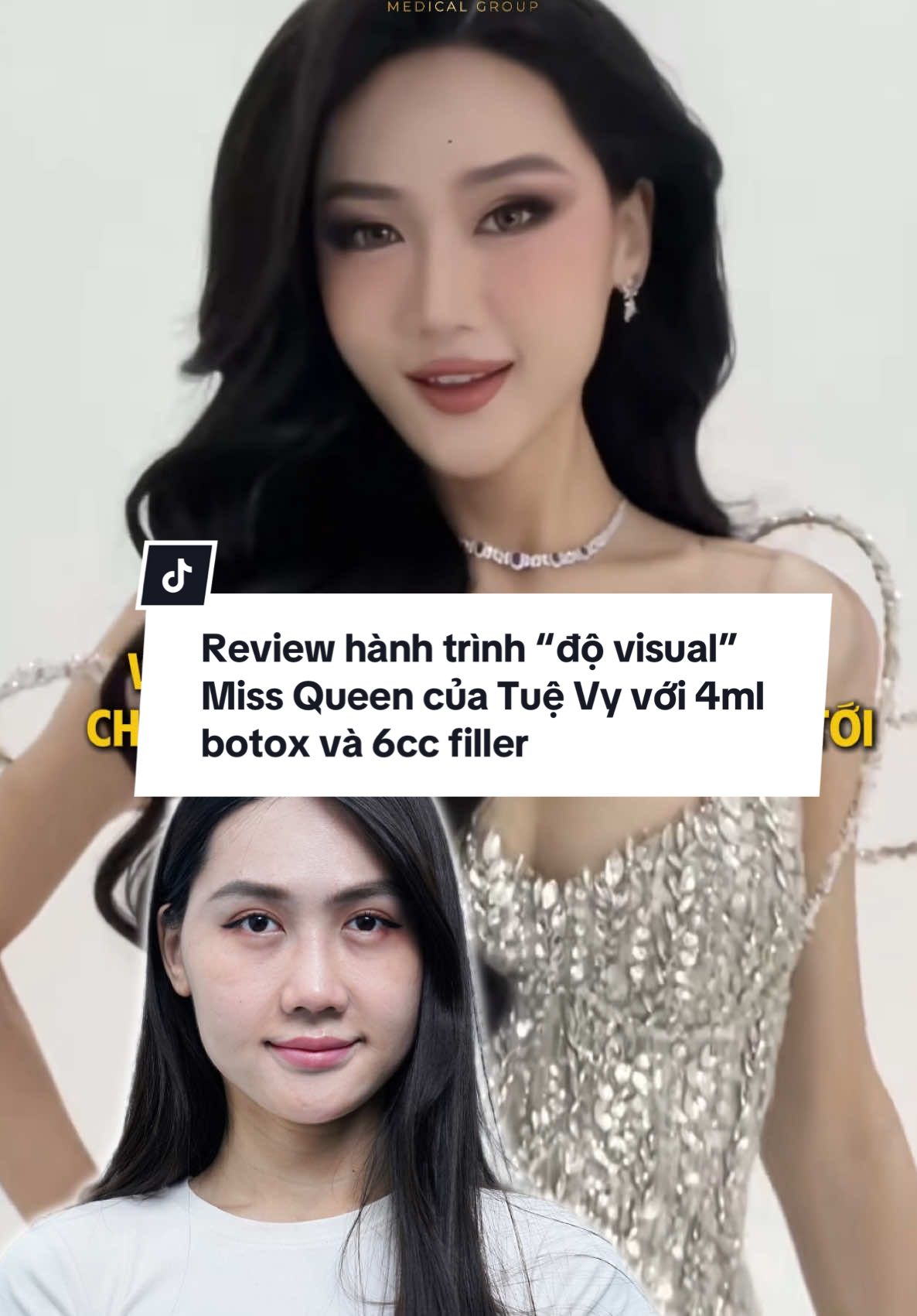 Review hành trình “độ visual” Miss Queen của Tuệ Vy với 4ml botox và 6cc filler   #filler #botox #reviewlamdep #orchard #BeautyReview 