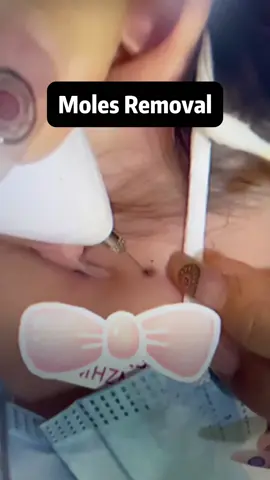 Mole and wart removal，very gentle and safe.#moleremovalpen  #skintransformat #beauty #healthcare #remove #tiktokshoprestock