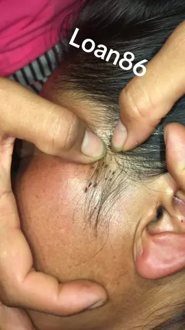 #lice #omg #liceremoval 