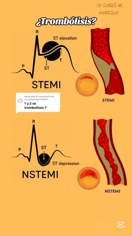 Respuesta a @user8262960793854 #trombolisis #stemi #ecg #ekg #electrocardiograma 