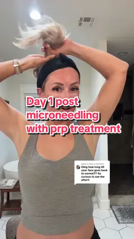 Replying to @Kelly looking better already huh 😆🤘🏼#vampirefacial #millennialmomsoftiktok #chelsieashley #microneedlingwithprp #prptreatment 