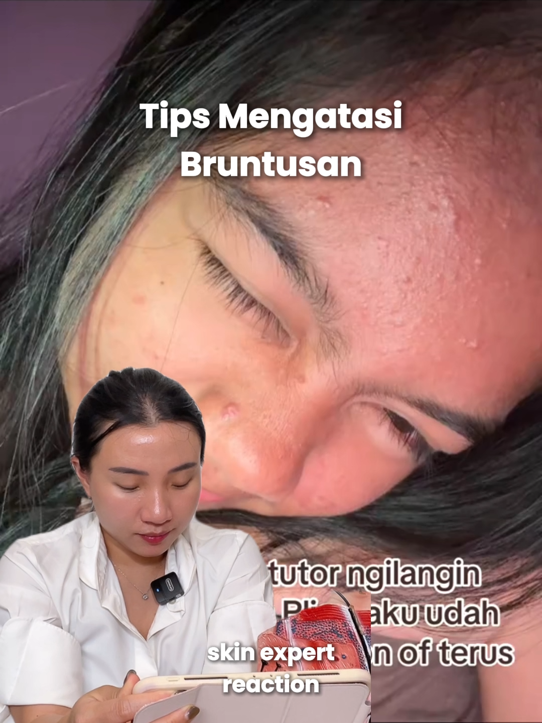 tips mengatasi bruntusan di area dahi! #funskincare #bruntusan