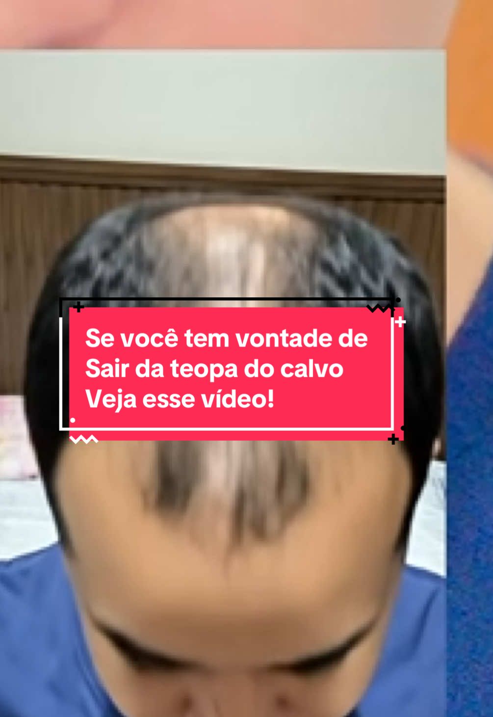 Saia da tropa do calvo🧑‍🦲 Por que o Envy Hair virou VIRAL? 🧵 1️⃣ Fórmula com 15 nutrientes selecionados 2️⃣ Óleos de abacate, argan, rícino e jojoba 3️⃣ 100% natural e vegano 4️⃣ Resultados visíveis em semanas! Desliza pra ver a diferença! ➡️ #EnvyHair #minoxidil #calvice  #calvo