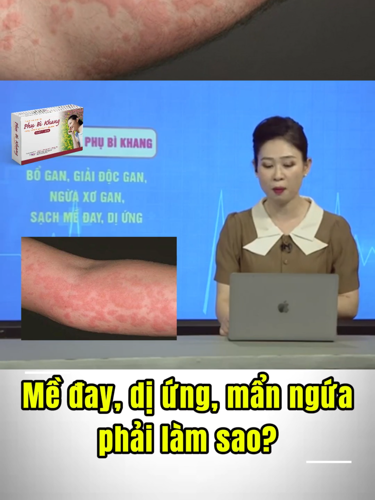 Mề đay, dị ứng, mẩn ngứa phải làm sao? #phubikhang #meday #diung #manngua #giamngua