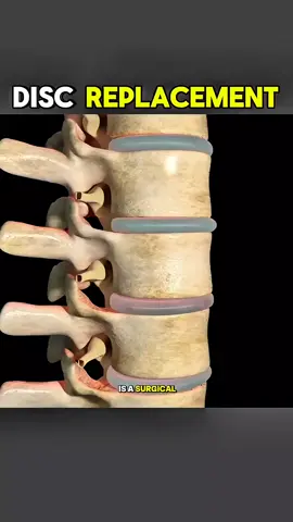Disc replacement surgery medical purposes #discreplacement #discreplacementsurgery  #discreplayflint #backbonesurgery #backsurgerycomingsoon #bulgingdisc #neurosurgery #casestudy #sundaycasestudy #ladyspinedoc #healthcareworker #hospital  #surgery #neurosurgeon #medicalschool 