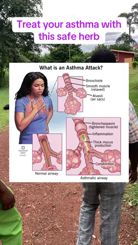 Treat asthma with Euphorbia Hirta. #asthma #herbsforasthma #healthcare 