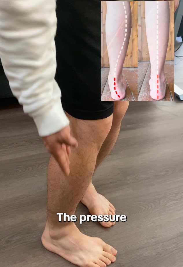 Don't wait until it is too late! #bunion #halluxvalgus #BunionRelief #BunionCorrector #magicfit 