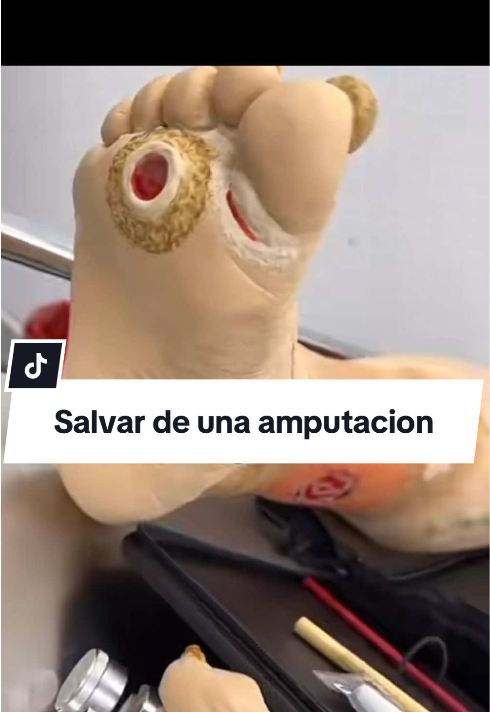 🫨Este consejo te va salvar de una complicación GRAVE o de una amputación si tú eres diabético y se te hace una úlcera en el pie 🦶🏻 🫨 #diabetes #piediabetico #heridas #cicatriz #curaciones 