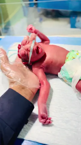 #CapCut# A Newborn baby Diagnosed by#Anencephaly is a severe neural tube defect in newborns where the skull and brain do not tremoved Bealert and the absence of malgraBRic content he brain and skull. It's a fatal condition, with most infants with anencephaly either stillborn or dying shortly after birth. Causes: Anencephaly is thought to result from a combination of genetic and environmental factors. Symptoms: Missing parts of the brain and skull, with exposed brain tissue in some cases. Smaller head size than normal. Infants with anencephaly are typically unable to see, hear, feel pain, or be conscious. Management in the NICU focuses on providing comfort and emotional support to the family, as well as addressing any immediate medical less Community Guidelines