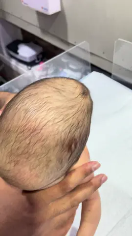 🩺 Baby Cephalohematoma – Assessment Tips Check baby’s head for a soft, swollen bump that does not cross suture lines. Monitor size daily, watch for changes in skin color, and report any rapid swelling or unusual behavior to the doctor. 👶💖 #Cephalohematoma #BabyCare #AssessmentTips #HealthMonitoring #LittleFighter 