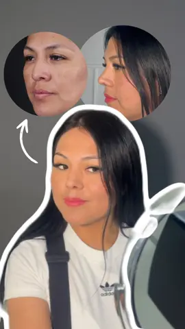 Rinoplastia + Elevación de tercio medio A un mes y medio de su cirugía, nuestra paciente luce un resultado espectacular tras su rinoplastia y elevación de tercio medio. El equilibrio en su rostro no solo realza su belleza, sino que también refleja la precisión y dedicación en cada procedimiento. 💎 Con el acompañamiento del Doctor Eleasar Nina, cirujano facial y otorrinolaringólogo, cada detalle está pensado para brindar armonía y naturalidad. #elevaciondeterciomedio #rinoplastia #experience #paciente #resultado 