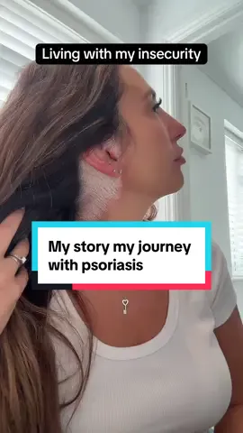 My story, my journey with psoriasis. #psoriasis #myjourney #storytime #psoriasisawareness #fyp