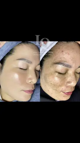 Cập nhập da nám của khách #chamsocdamun#chamsocdanam #chamsocseo#lequynhspa#hocnghespa