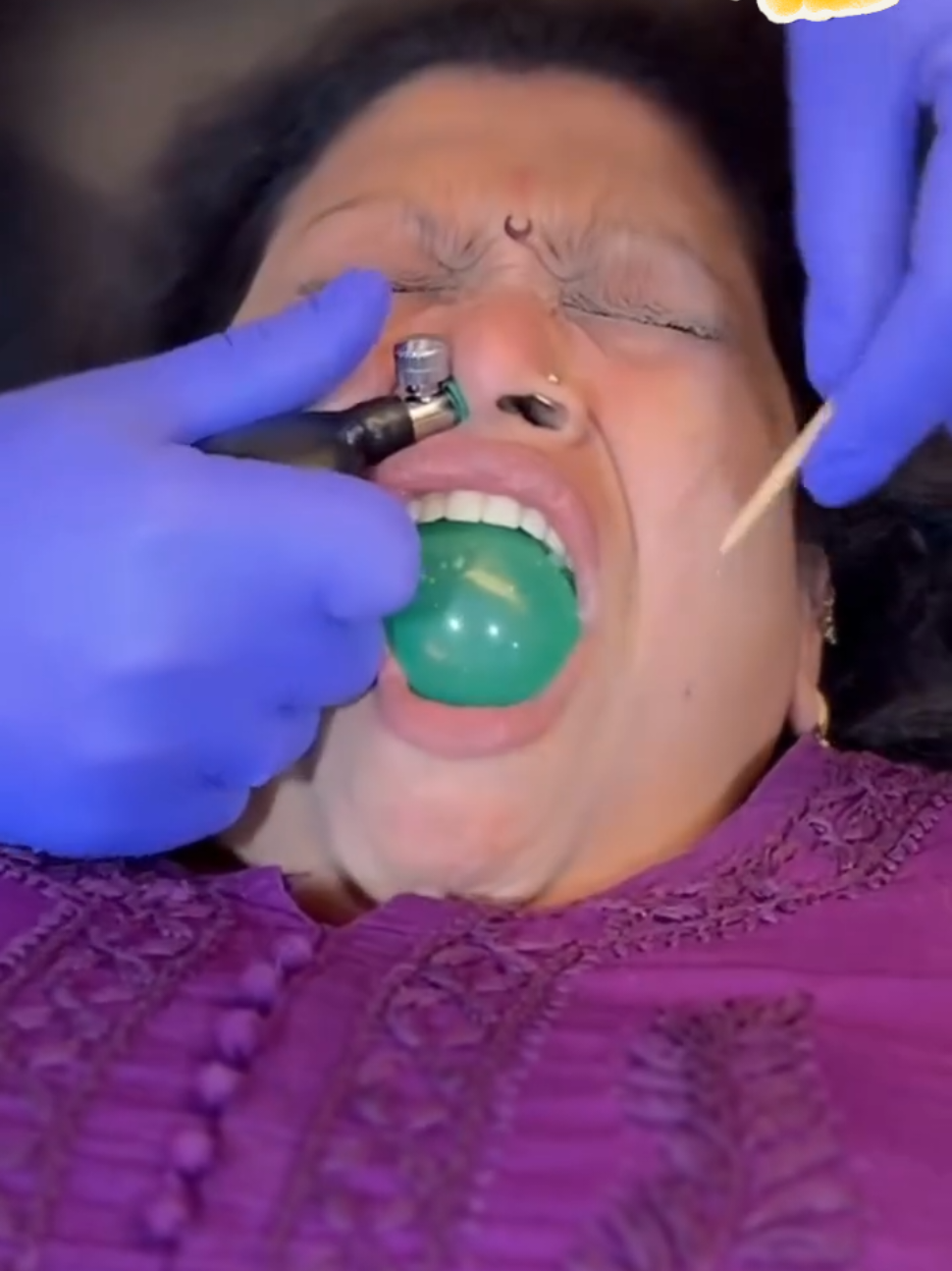 CFR for Facial Pain treatment 