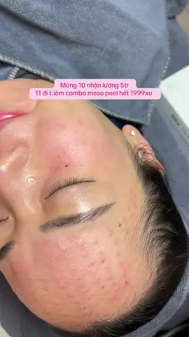 Chịu khó chịu cực …nhưng chị hông chịu được xấu á #mayspa #meso_căng_bóng_trắng_sáng #peel_sáng_da_mờ_thâm #meso_trắng_da #trị_mụn_chuẩn_y_khoa 