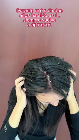 Si tienes cabello graso y caspa, prueba este champú con disulfuro de selenio. Es muy eficaz para controlar la grasa y eliminar la caspa. #anticaspa #controlgrasa #champú #cuidadocapilar #FallFreshness