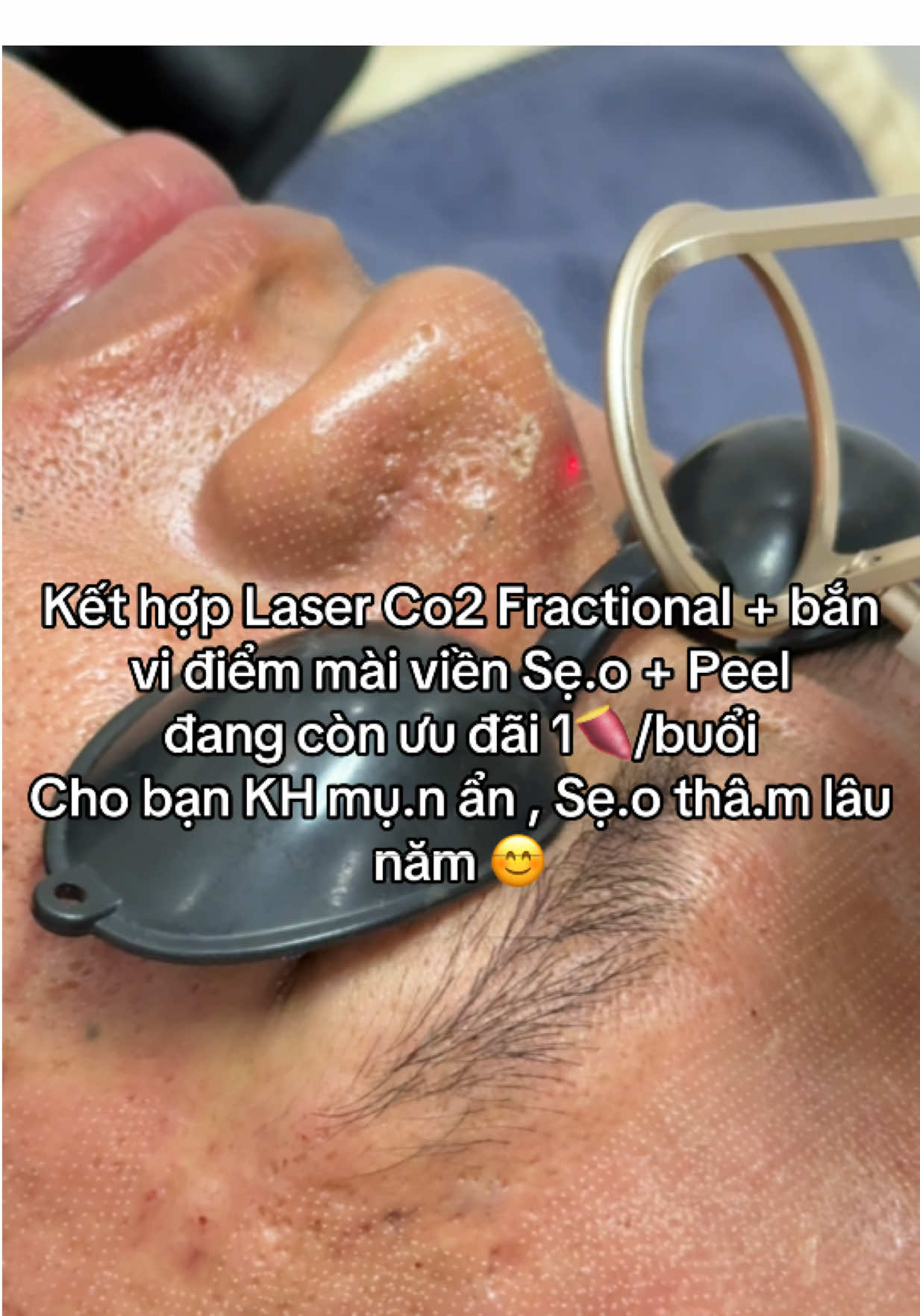 Cải thiện sau buổi đầu.  Mụ.n thâ.m sẹ.o lcl to tànnhang mạnh dạn i.b Misa t.v nè ☺️#misalamdep #dieutrimun #dieutriseo #dieutrimunchuyensau #xuhuong 