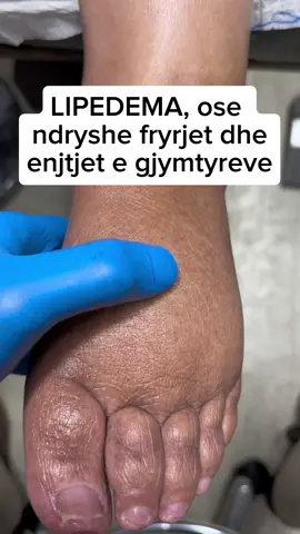 I ke dhe ti këmbët e enjtura 🥺 #foryoupage❤️❤️ #fyp #viralvideos #albaniangirl #albania🇦🇱 