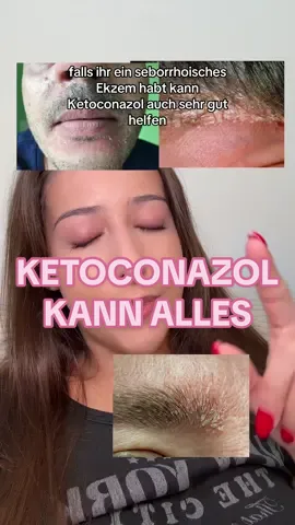 👉 Fungal Akne? Oft sind Hefepilze schuld – kleine, juckende Pickel, die wie normale Akne aussehen. ✨ Ketoconazol hilft! Ob als Shampoo oder Creme – es bekämpft Pilze, reduziert Entzündungen und klärt die Haut. Weitere Benefits von Ketoconazol: 	•	Gegen seborrhoisches Ekzem 🧴 	•	Stoppt Schuppen ❌ 	•	Unterstützt sogar Haarwuchs 💆‍♂️✨ #ketoconazol #fungalakne #fungalacne #akne #hautpflege 