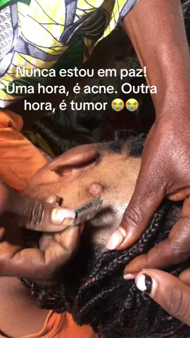 #acne #tumor  #tiktokviral 