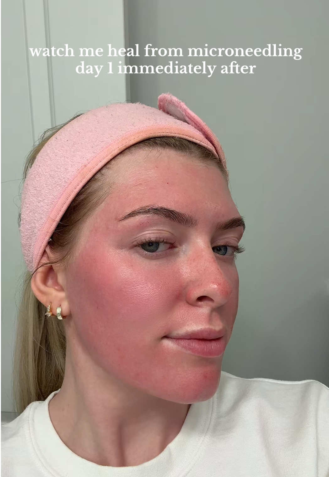 love love love microneedling!!!  #microneedling #skin #esthetician #glowingskin #skincare 