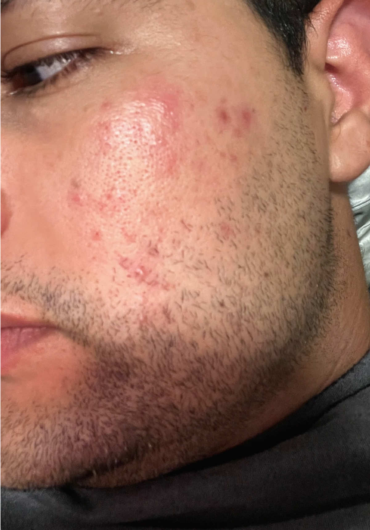 Lo mejor en el cuidado de la piel lo tiene @Dr.Althea US 😍 mi piel esta radiante otra vez #oilyskin #dralthea #acneproneskin #manchasdeacne #koreanskincare 