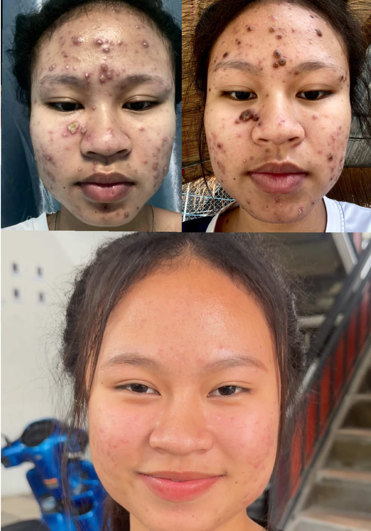 ใครจะเชื่อว่าหน้าน้องดีขึ้นมาก #สบู่ใบชา #สบู่ใบชาสูตรแพทย์แผนไทย #สบู่ใบชารักษาสิว #สเปรย์ใบชา #เซรั่มใบชา 